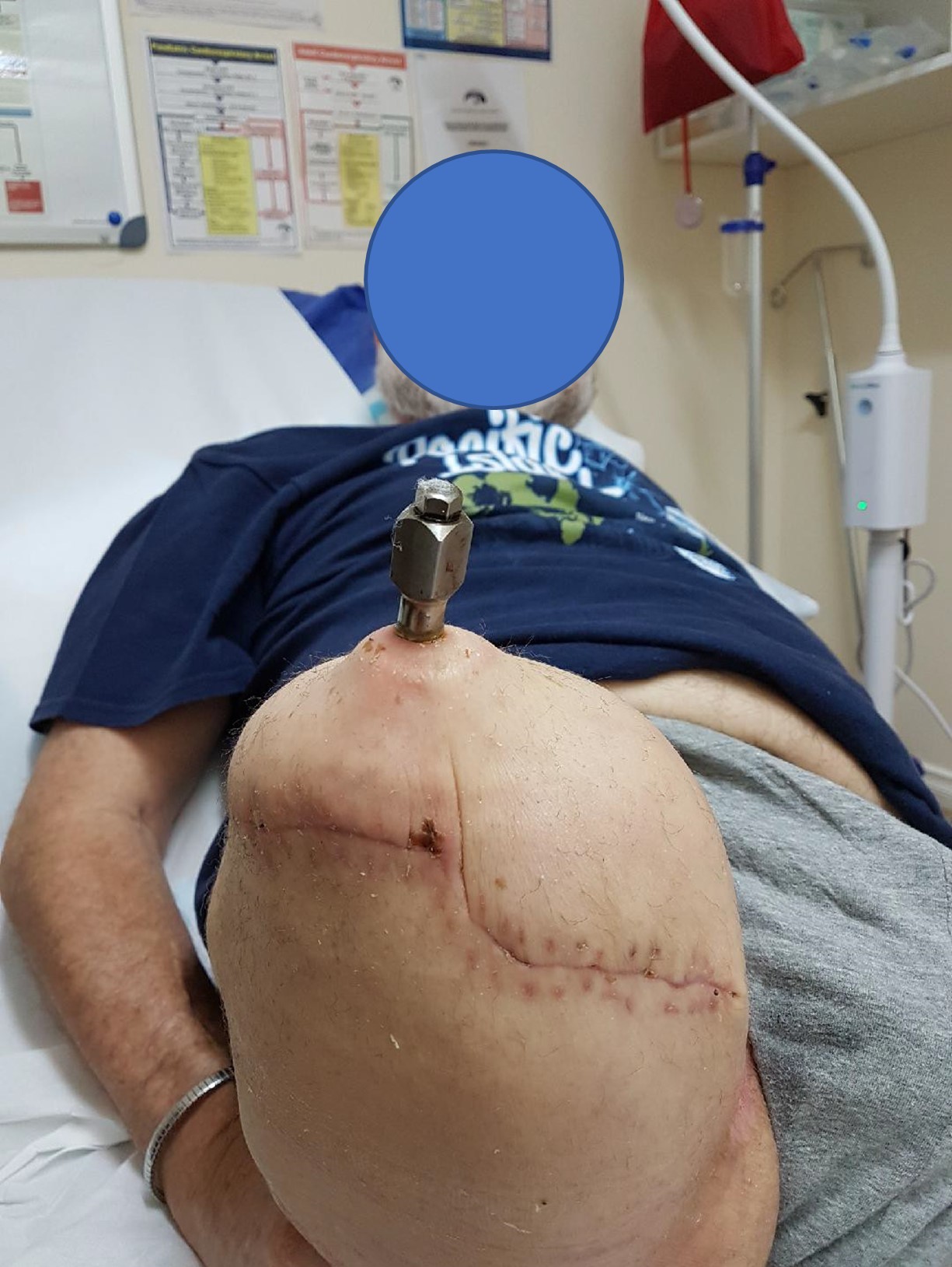 Figure 4 - Metal soft tissue interface (transfemoral)