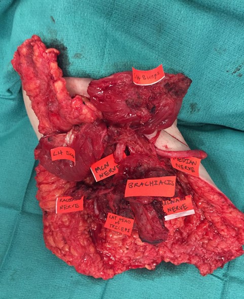 Figure 7-Tranhumeral amputation
