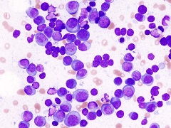 Multiple myeloma