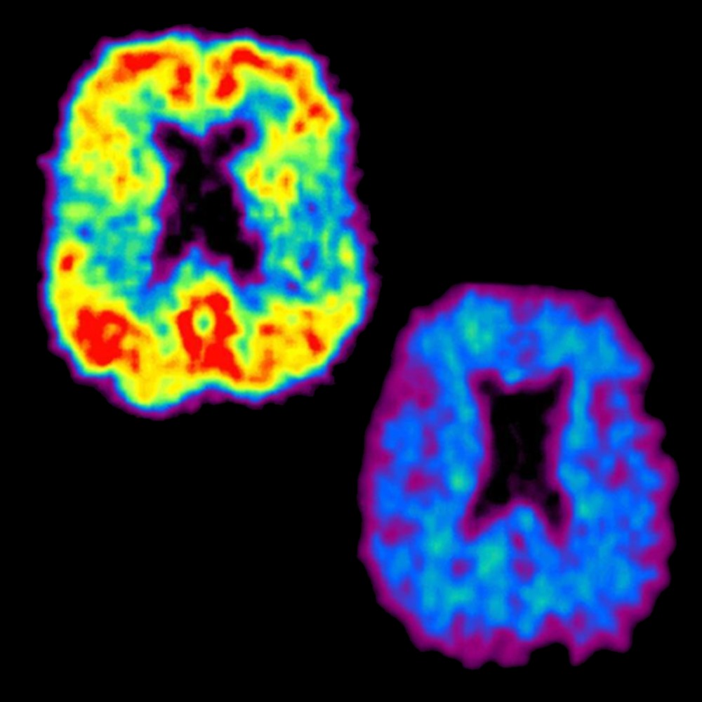 Ep138: Amyloid busters- the benefit and the burden